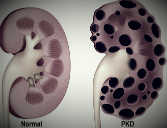 Niere mit/ ohne PKD